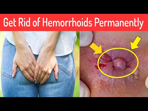 How to get rid of Hemorrhoids Permanently - 12 Best...