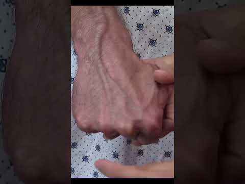 اي هو ال Rolling Vein؟!