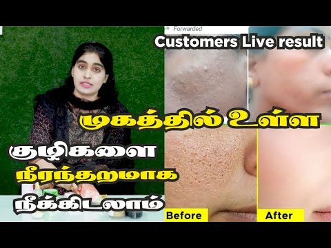 Close Large OPEN PORES in1week tighten and brighten skin Naturally | முகத்தில் உள்ள குழிகளை நீக்க...