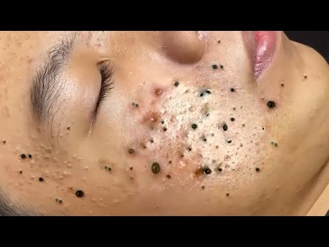 Big Cystic Acne Blackheads Extraction Blackheads & Milia, Whiteheads Removal Pimple Popping # 46692