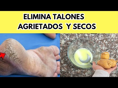 Me puse Papas en los pies y ¡mira lo que pasó!  Pies AGRIETADOS Y SECOS