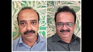 Happy Client of Hair Transplant sharing his result