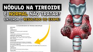 NÓDULO NA TIREOIDE: É SEMPRE CÂNCER!? O que fazer?
