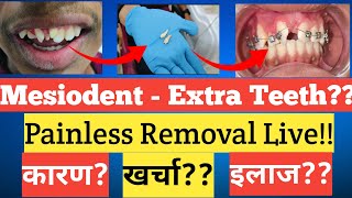 Bina Dard Ke Dant Nikalne Ka Tarika |Painless Tooth Removal |बिना दर्द के दांत कैसे निकलते हैं |Cost