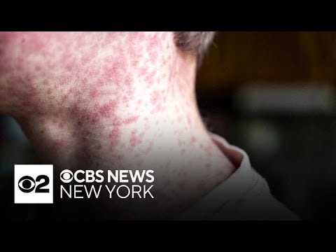 YouTube video thumbnail: 2 Measles Cases Confirmed in Manhattan, Bringing Citywide Total to 14 in 2025