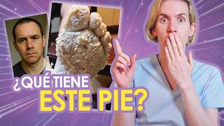 HOMBRE con PIE VERRUGOSO se VUELVE VIRAL - ¿Te puede pasar a vos? ¿QUE TIENE? Chisme dermatologico