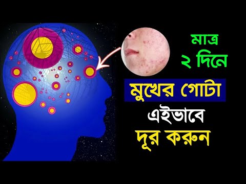 মাত্র ২ দিনে মুখের ব্রণ দূর করার টিপস | How to Remove Your Facial Pimples Without Investing Money