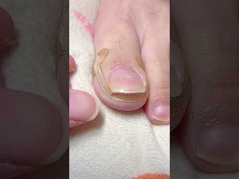 Say Goodbye to Ingrown Toenails with These Simple Stickers( # 2609  ) 1️⃣