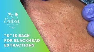 K Is Back for Blackhead Extractions