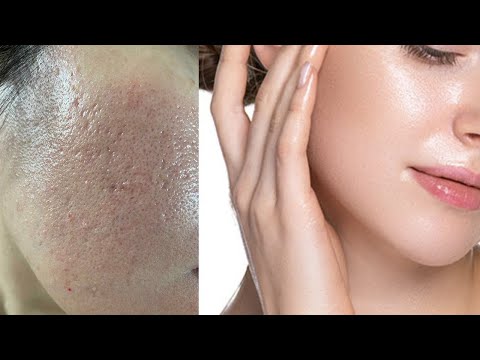 3 Jours pour Faire Disparaitre Cicatrices, Pores et Trous sur la peau du visage |resserrer pores