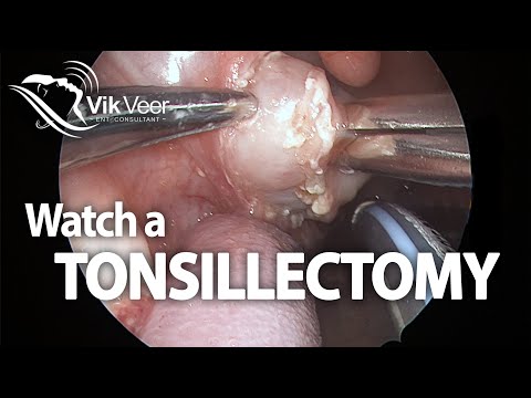 Watch a Tonsillectomy Operation