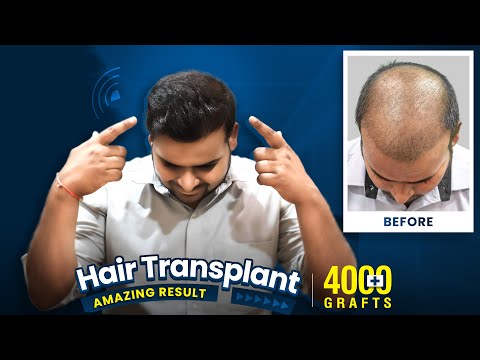 4000 Grafts Hair Transplant in Nagpur | Best Hair Transplant Results & Cost in Nagpur