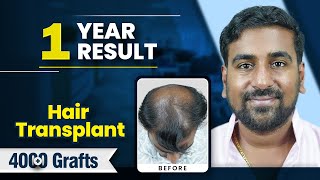 4050 Grafts Hair Transplant in Pune | Amazing Results & Affordable Cost in Pune #hairtransplant