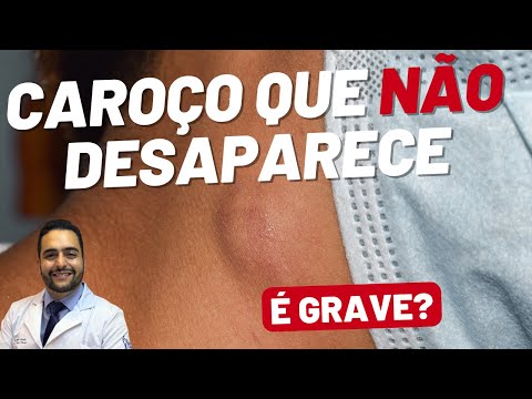 Caroço no Pescoço Que Não Some: Quando se Preocupar?