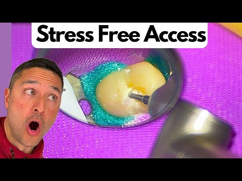 Root Canal Access Through a Crown {2 Tips}