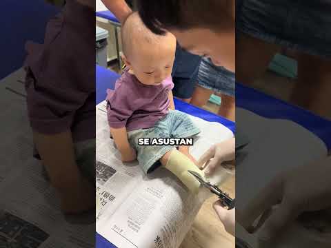 ¡Mira lo que hizo el bebé cuando le quitaron el escayola!😍😇