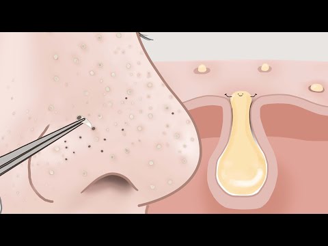 코피지 핀셋으로 뽁뽁!! 피지뽑기 시각적팅글 ASMR 애니메이션 / 루루팡