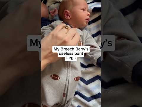 My breech baby A ๐ฅน #twins #breechbirth #breech