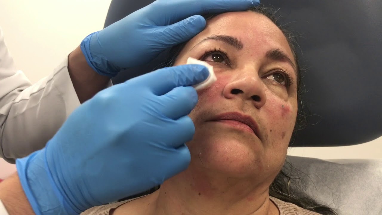 Woman receiving skincare treatment in clinical setting.