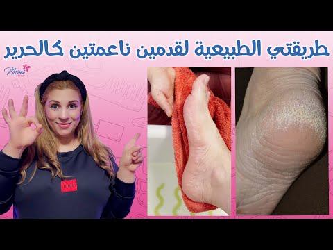 أسرع طريقة للتخلص من تشقق  وتفسخ القدمين بوصفة طبيعية فعالة