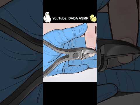 ASMR｜Ingrown Toenail and Corn removal treatment animation | 凍甲(甲溝炎＆雞眼治療動畫｜내성발톱&티눈 치료｜魚の目の芯を取る 巻き爪治療2