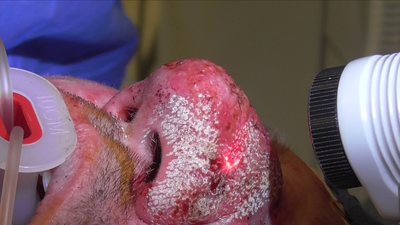 Medical procedure focusing on a patient's nose.
