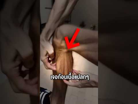 ก้อนอะไรอยู่ที่ขาชายคนนี้? #shorts