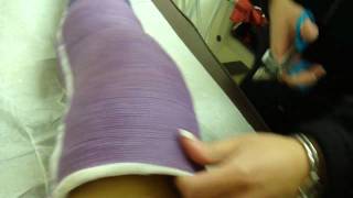 Perfect purple long leg cast llc