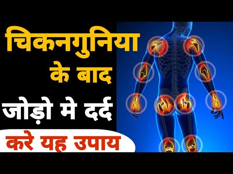 चिकनगुनिया के बाद जोड़ो के दर्द का ईलाज।chikungunya joint pain treatment hindi#chikungunya#jointpain