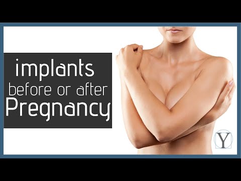 Breast Implants Before and After Pregnancy