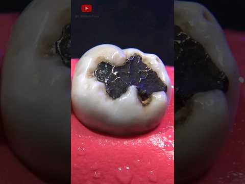 Restauración dental  #satisfying