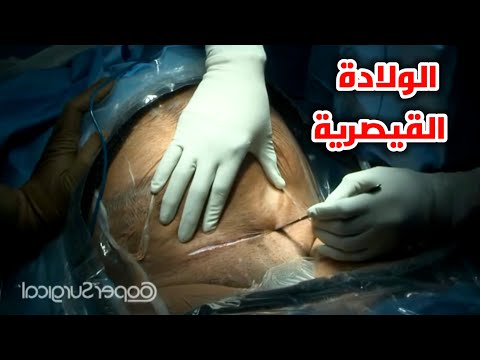 شاهد عملية الولادة القيصرية وقل(سبحان الله الخالق) Cesarean section : Surgical technique - HD Video