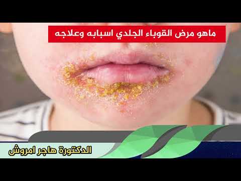 ماهو مرض القوباء الجلدي اسبابه وعلاجه الدكتورة هاجر امروش