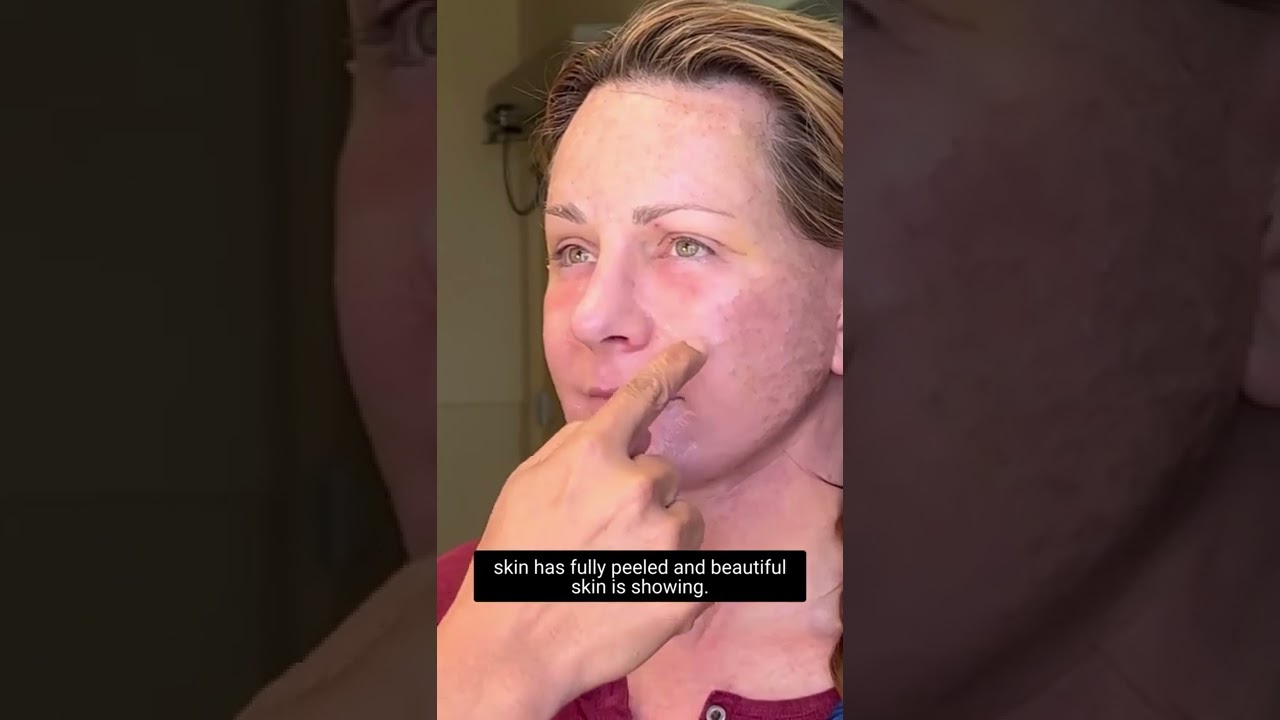 Woman showing her newly peeled skin results.
