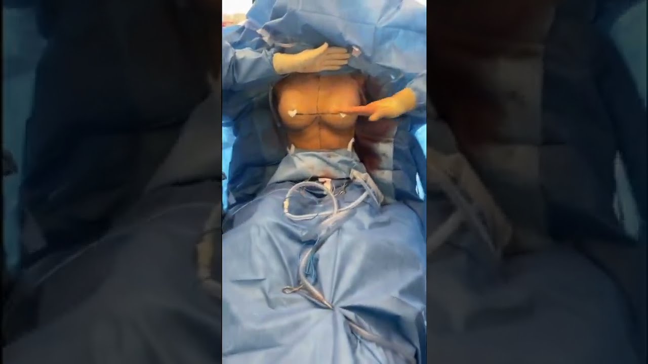 Breast Augmentation with a Hidden Scar! Through the Armpit Breast Implant Insertion Technique!