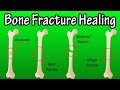Bone Healing and Nutrition Concepts