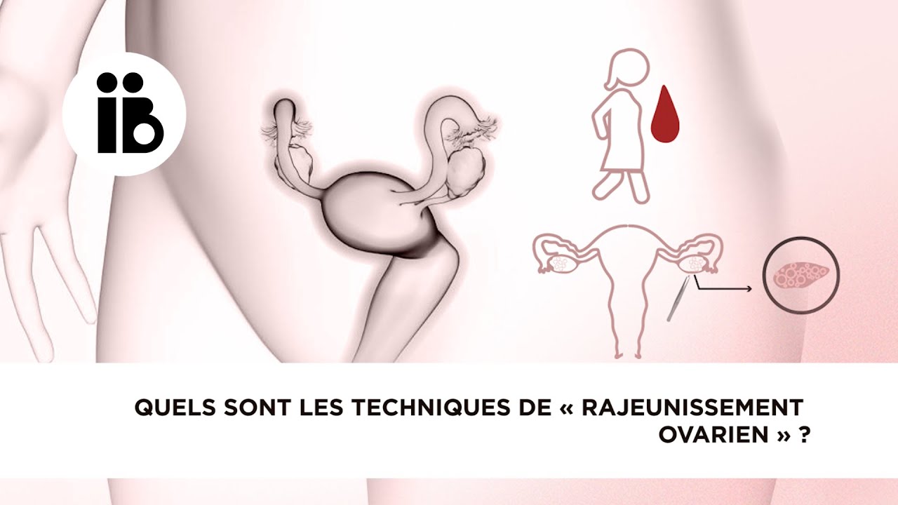 Quels sont les techniques de « rajeunissement ovarien » ?
