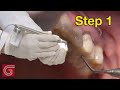 Decontamination Techniques for Dental Crowns