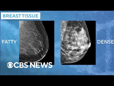 YouTube video thumbnail: Doctors Using AI Mammogram Readings to Predict Breast Cancer Risk