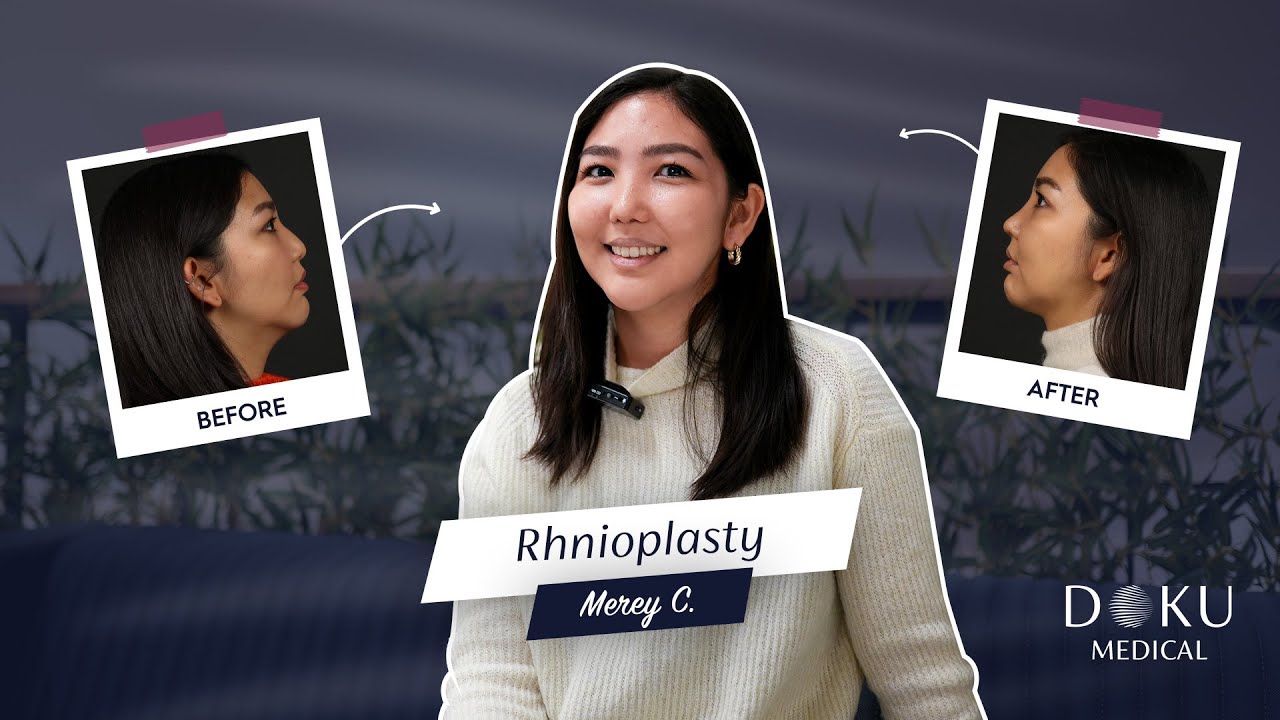 #Rhinoplasty – Nose Surgery Entire Process / Transform your look with Rhinoplasty!