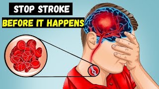 12 Powerful Foods to Melt Blood Clots & Stop Strokes – Naturally!