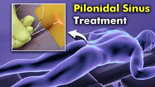 How Sinus Laser Treatment Works – Step-by-Step Guide with Animation