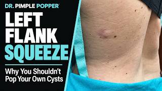 Why You Shouldn't Pop Your Own Cysts | Dr. Pimple Popper vs. Flank Squeeze