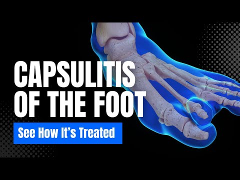 Capsulitis of the Foot Explained | Understanding 2nd MTP Synovitis