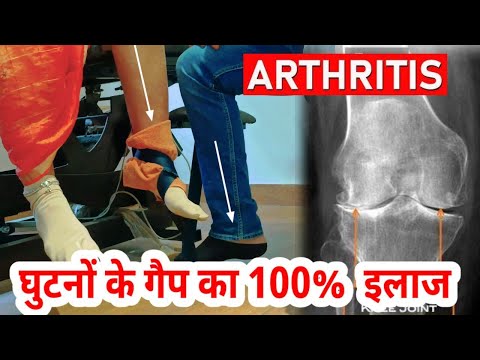 घुटनो में गैप आ जाये तो क्या करे | knee gap treatment without surgery | Knee decompression