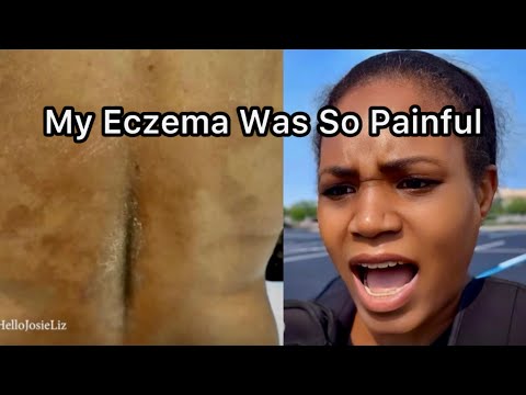 Before and After Eczema Pics: How Do An Elimination Diet For Eczema Relief