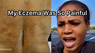 Before and After Eczema Pics: How Do An Elimination Diet For Eczema Relief