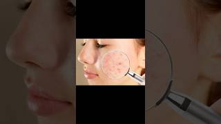 ഒരു ദിവസം കൊണ്ട് മുഖക്കുരു മാറ്റാം 😱How to remove pimples home remedy Malayalam #tips #skincare