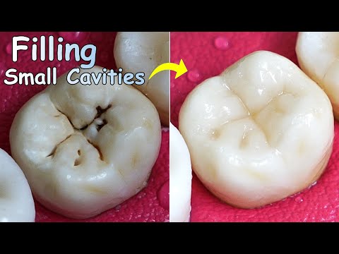 The Amazing Way of Doing Tooth Restoration | Repairing Pit and Fissure Caries