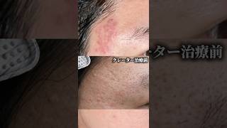 クレーター治療の参考にしてね。